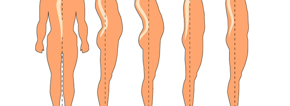 haltungsschaeden-durch-physiotherapie-in-borken-effektiv-behandeln