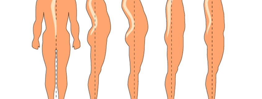 haltungsschaeden-durch-physiotherapie-in-borken-effektiv-behandeln